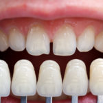 How to Decide if Dental Veneers are the Right Choice for You