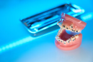How to Know if You Need Braces